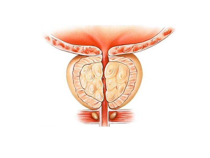 Entzündung der Prostata